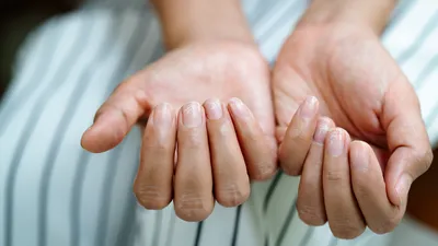 Broze, beschadigde nagels na gebruik van gellak.