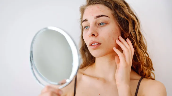 Beautiful woman with problematic skin works in her small mirror. Cosmetology. Skin care concept.