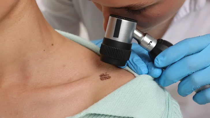 Dermatologen slaan alarm: "Stop met routinematig je moedervlekken te laten checken"