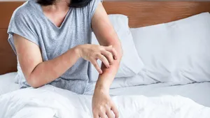 Hoe herken je een zonneallergie?