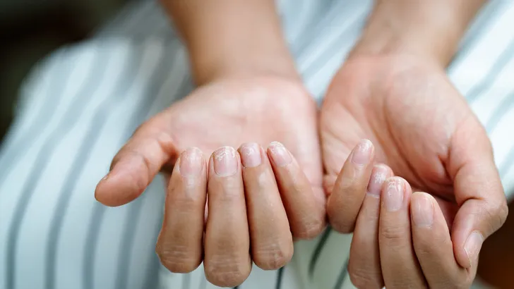brittle damaged nails after using shellac or gel-lacquer