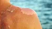 Skin peeling