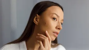 Upset young woman in white bathrobe examines pimples on her face. Portrait of girl removing pimples in the bathroom. Beauty and health of the problematic skin.