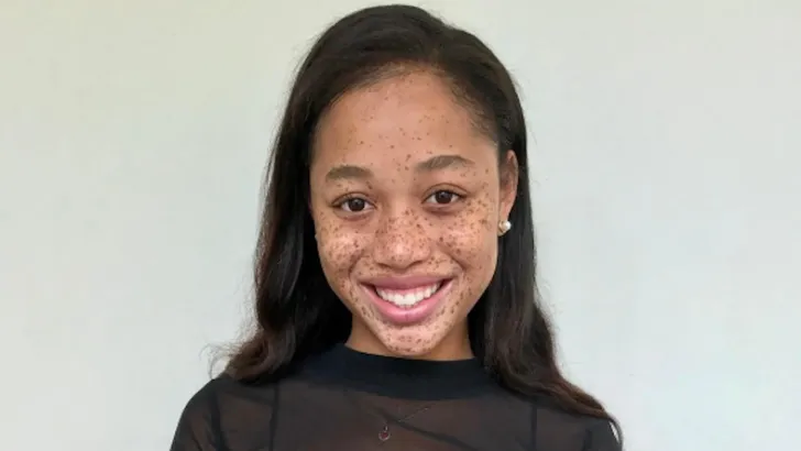 Meisje dat gepest werd om haar sproeten is nu model