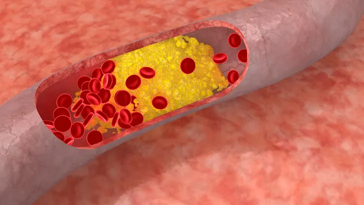 Eindelijk hoopvol nieuws voor wie worstelt om een hoog cholesterol te verlagen