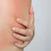 Geirriteerde huid met warmtebultjes