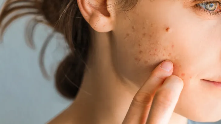 Hormonale acne: dit is het en zo kun je het bestrijden