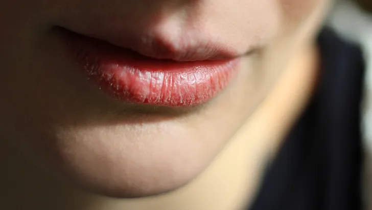 droge schrale lippen 