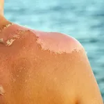 Skin peeling