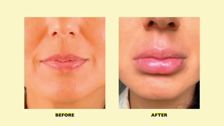 Tried & tested: Lip plumper voor volle lippen zonder plastische chirurgie