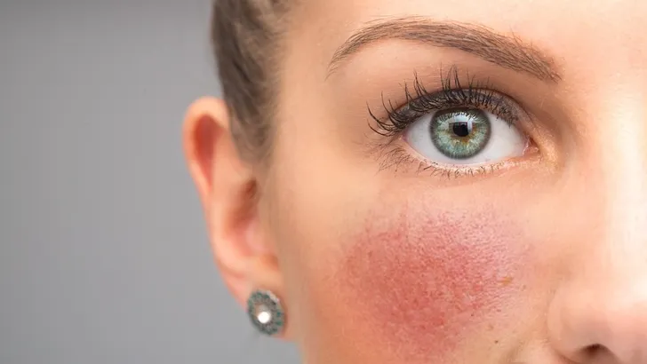 Huidtherapeut over Rosacea – Close-up foto van vrouw met rosacea op de huid.