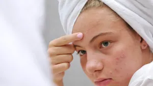 A sad teenage girl is looking at the pimples on her face in the mirror. Problematic skin. Acne.