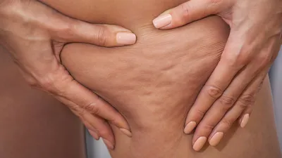 Lipoedeem of cellulitis: waarom dit onderscheid herkennen cruciaal is voor je gezondheid