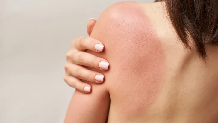 Zonnebrand op de schouder van een vrouw.