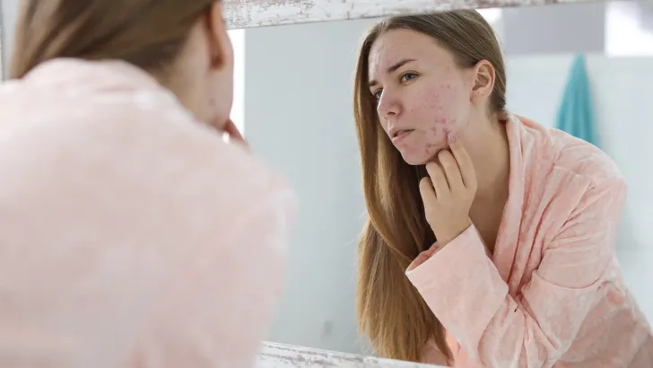 Young woman with acne problem near mirror in bathroom