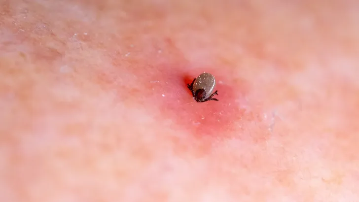 Een teek in de huid van een persoon