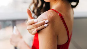 Close up of woman applying moisturizer on sunburned skin