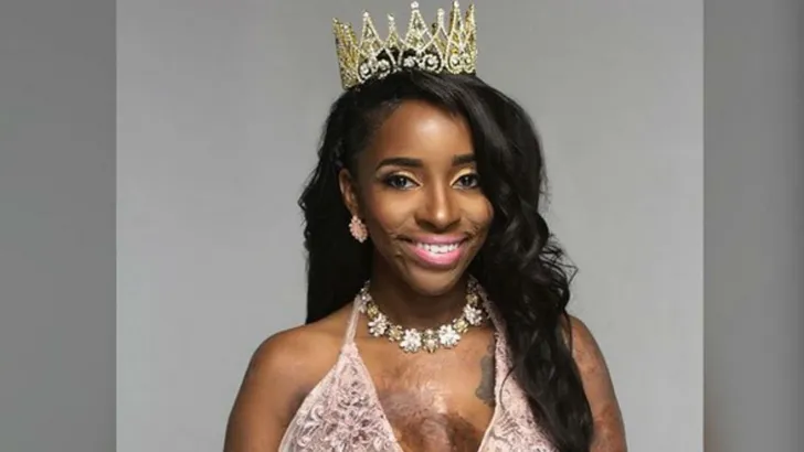 Vrouw met brandwonden straalt in prachtige zwangerschapsshoot