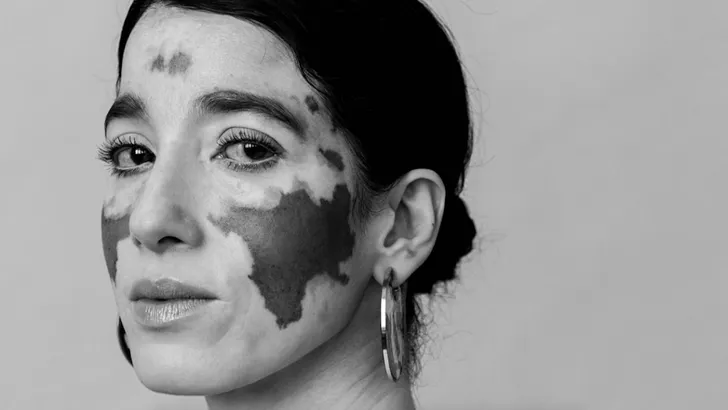 Real life: 'Het resterende bruin op mijn gezicht is een kunstwerk'