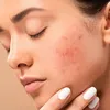 Dít zijn de beste fillers tegen acne littekens volgens experts | Grazia