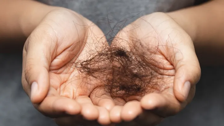 haartransplantatie