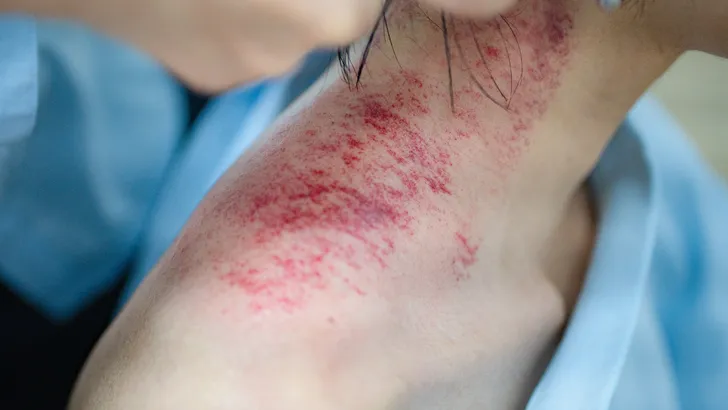 vrouw wordt behandeld met een Gua Sha hoorn
