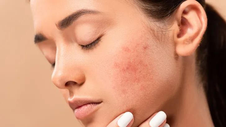 Een vrouw met acne op haar wang