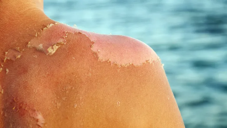 Skin peeling