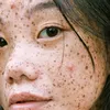 Déze skinfluencers laten op Instagram zien dat een oneffen huid normaal is
