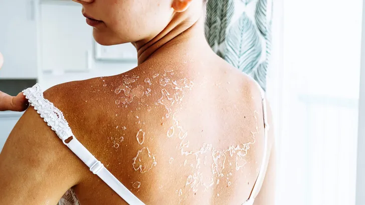 dry flaky skin on back of teenage girl