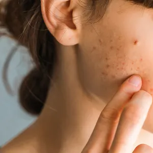 Hormonale acne: dit is het en zo kun je het bestrijden